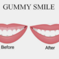 gummy-smile