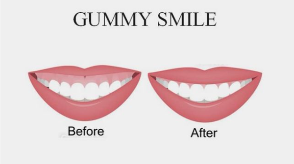 gummy-smile