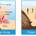 horlama-apareyi-nedir-